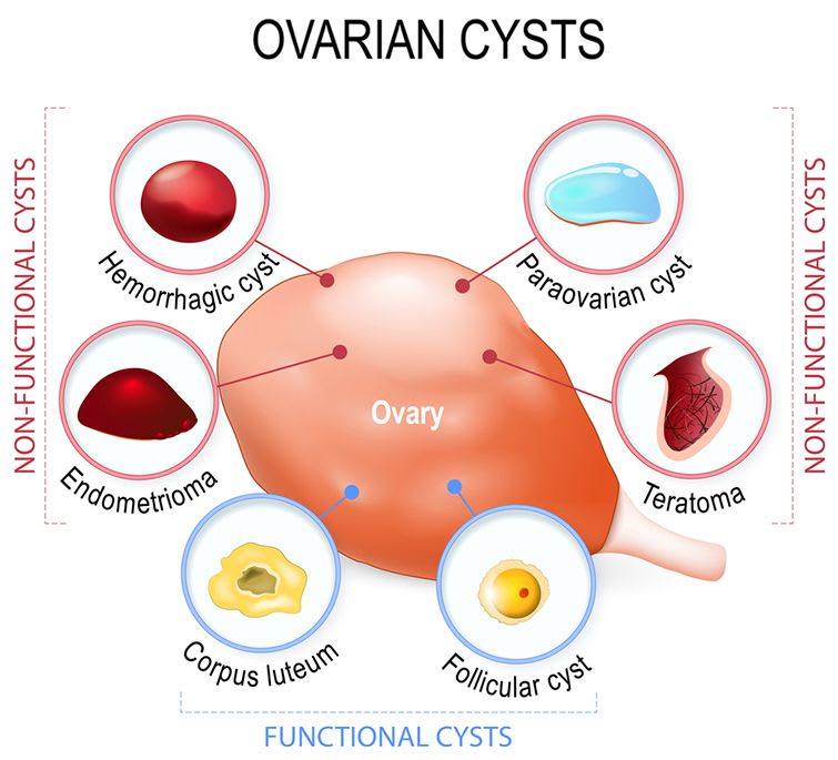 Ovarian Cysts Types Causes Symptoms And Treatment